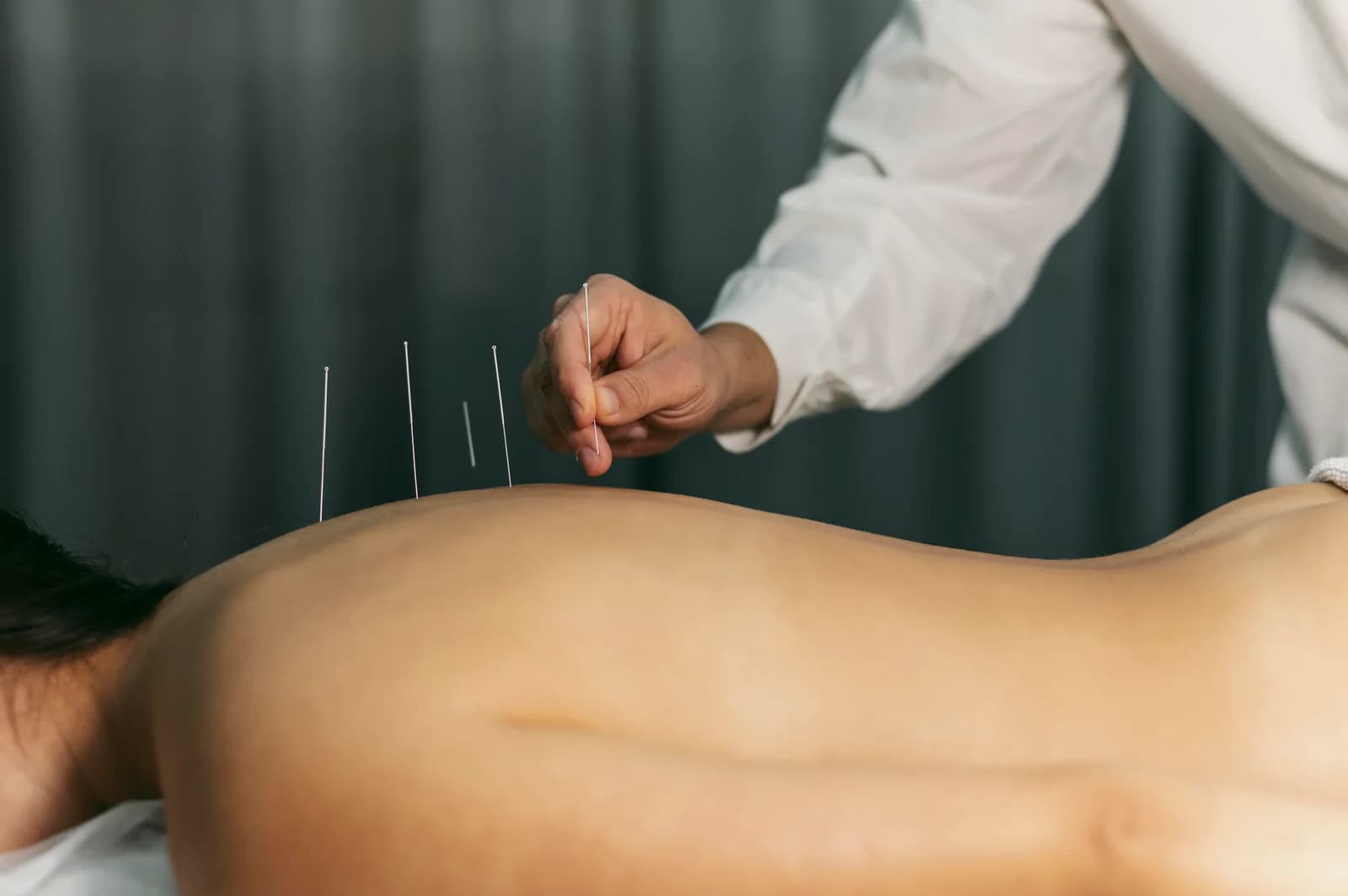 أطباء وخز بالإبر في الأردن — جلسة علاج باستخدام إبر الوخز — دليل أفضل أطباء وخز بالإبر في الأردن