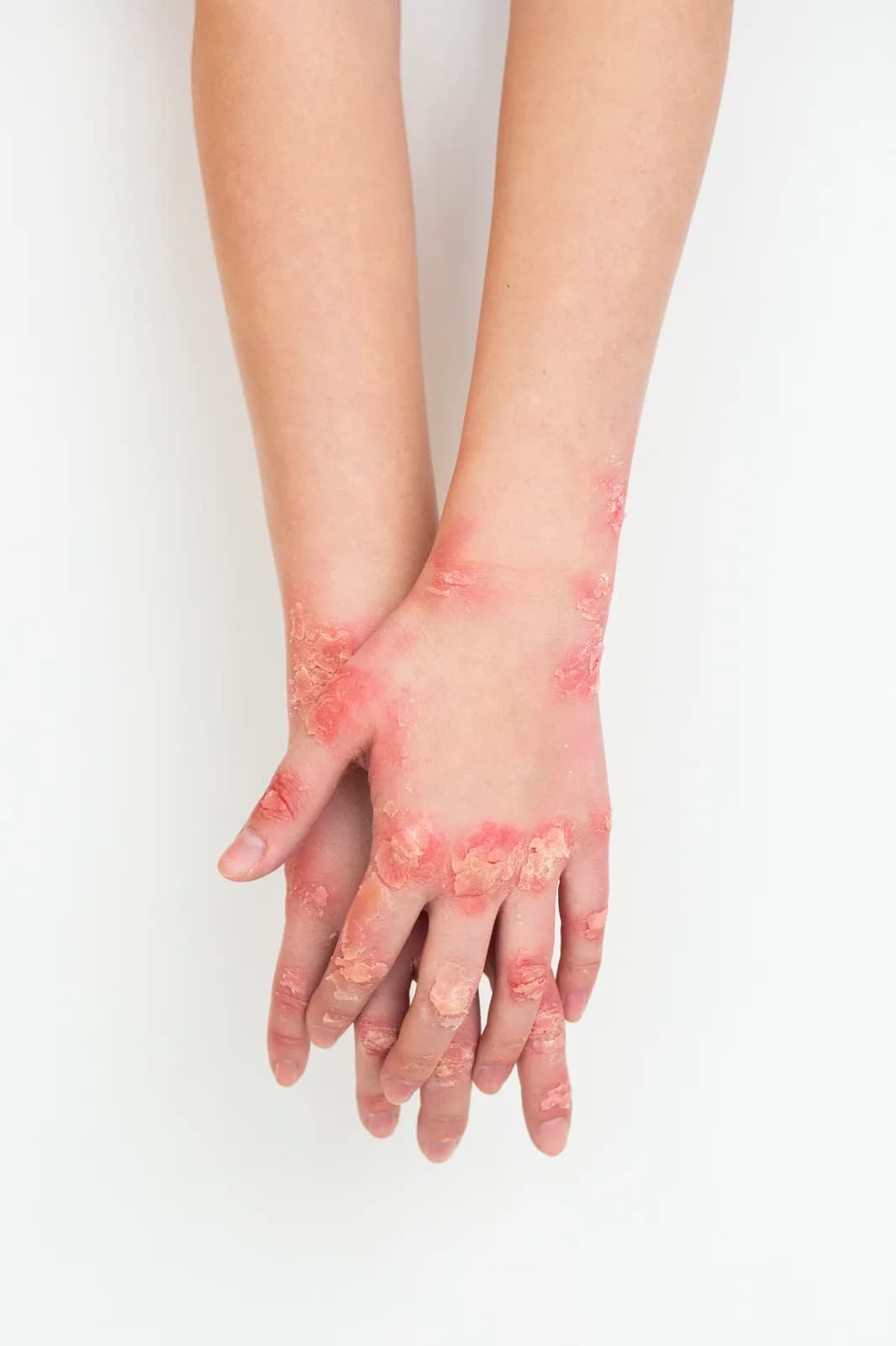 الصدفية (Psoriasis): الأعراض، الأنواع، وأحدث العلاجات — تعريف بمرض الصدفية المناعي، أنواعه المختلفة، وأحدث العلاجات المتاحة لتحسين الأعراض.